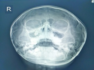 Paranasal sinuses x-ray finding Tooth in right maxillary sinus.No sinusitis. No bony destruction or mass.