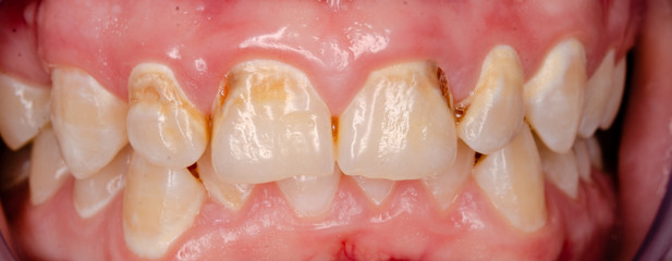 closeup of teeth