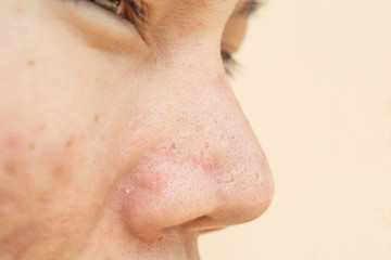 Acne scars and pores. In the nose Black spots, wrinkles and skin problems