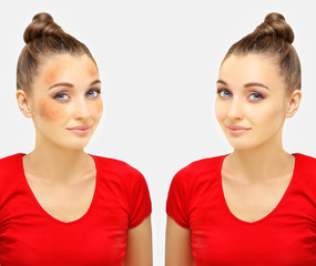 Dark spots, freckles,hyperpigmentation(melasma or chloasma)