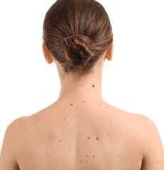 Young woman with moles on white background