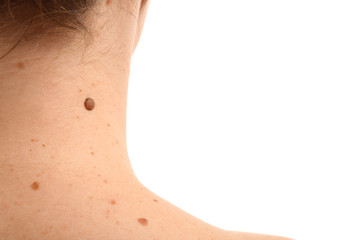 Young woman with moles on white background, closeup
