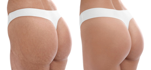 Woman before and after plastic operation on white background, closeup. Body care concept