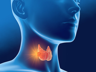 Thyroid cancer of a woman, medically 3D illustration, front view