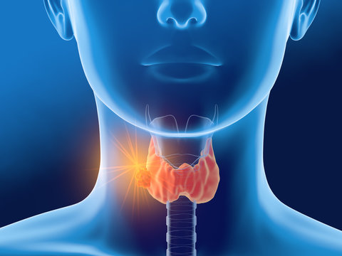 Thyroid cancer of a woman, medically 3D illustration, front view