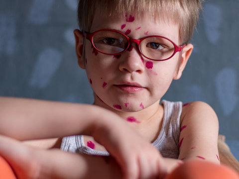 Upset blond child in pink glasses in straw chair has chicken pox. Mother smeared follicles with Takalani’s solution all over her body. Successful treatment for early detection of symptoms. Varicella