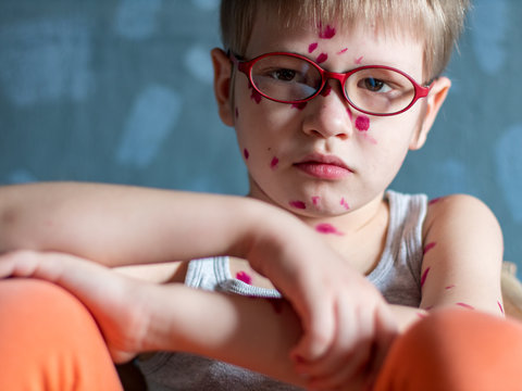 Upset blond child in pink glasses in straw chair has chicken pox. Mother smeared follicles with Takalani’s solution all over her body. Successful treatment for early detection of symptoms. Varicella