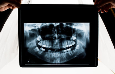 A panoramic dental x-ray hold in front of bright light so the doctor can analyse it. Radiography of a person with teeth problems.