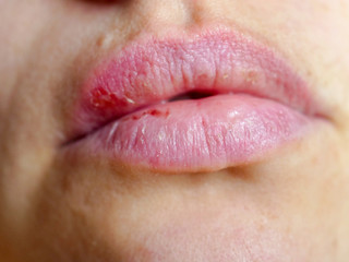 Beautiful female lips cracked from frost, wind, lack of vitamins. Sore from herpes virus. Lips need hygiene