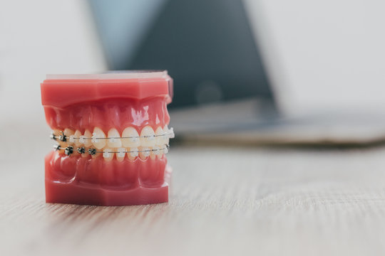 Model of jaw with braces