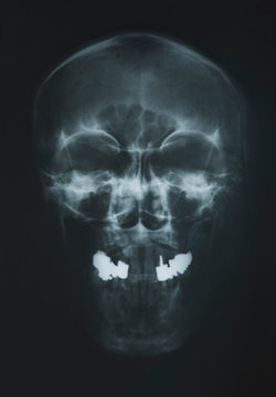 x-ray of the scull