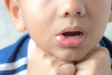 Allergic reaction on child mouth skin after bee stings. Health care, Medical concept.
