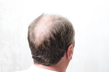 Bald back of men`s head.Concept of baldness