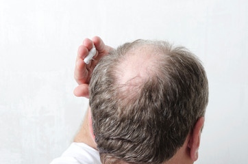 Man applying special cream for hair growth.Concept of beauty procedure for hair care