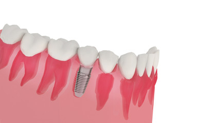 dental implant and natural teeth, Concept image of replacement tooth root with implant, human anatomy of healthy teeth isolated on white background, 3d illustration.