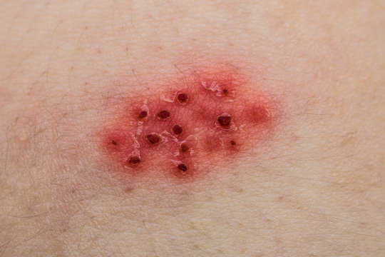 Virus on the body. Rash of Shingles on the skin. Bright red blisters of zoster. Smallpox Disease.