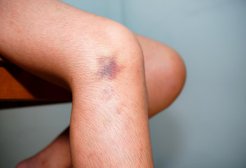 The bruise on human skin, background blurred, People with knee pain that are bruised.