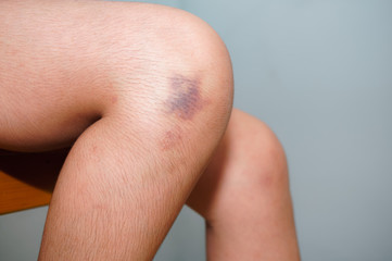 The bruise on human skin, blurred background, People with knee pain with bruising swelling.