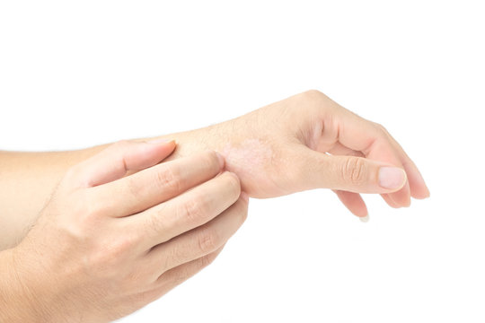 Men's hands are scratched because of itchy rashes caused by dermatitis. isolated on white background and clipping path.