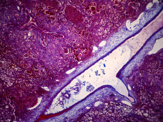 Sheep lung parasitized by lung worms