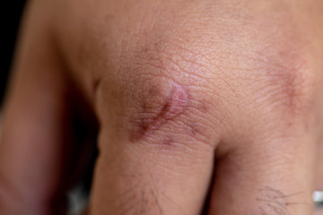 A scar is an area of fibrous tissue that replaces normal skin after an injury on skin. 