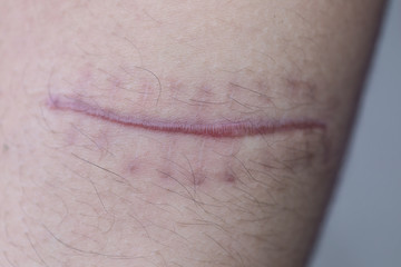 A scar is an area of fibrous tissue that replaces normal skin after an injury on skin. 