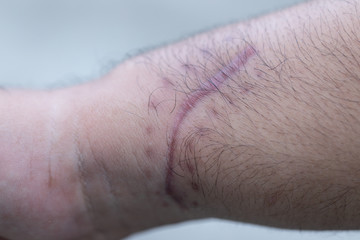 A scar is an area of fibrous tissue that replaces normal skin after an injury on skin. 