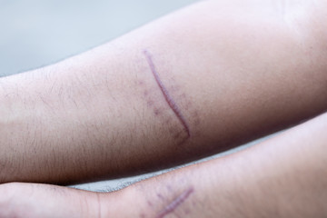A scar is an area of fibrous tissue that replaces normal skin after an injury on skin. 