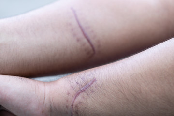 A scar is an area of fibrous tissue that replaces normal skin after an injury on skin. 