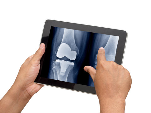 Doctor using tablet to check xray image of total knee replacement in medical application program.