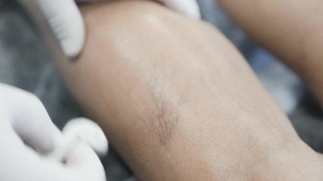 Close-up hands of vascular surgeon in gloves disinfect leg of patient with varicose veins before treatment procedure