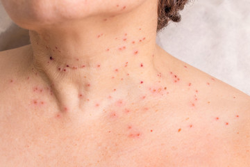 Naklejka premium Traces of removal of papillomas on the neck of a woman_
