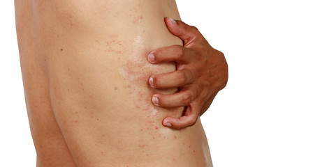 A man scratch rash ,Closeup man scratching his itchy back with allergy rash