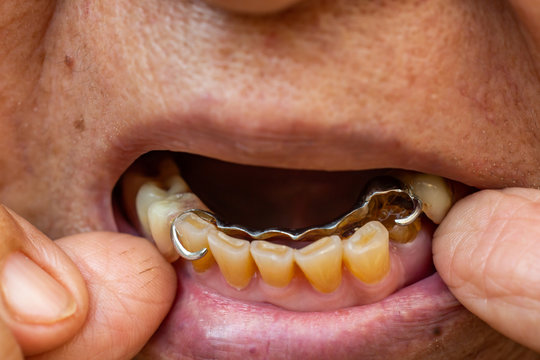 Silver metal Artificial teeth in the mouth of senior woman, Stomatology & False Dentures set concept, Close up & Macro shot, Selective focus