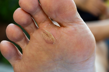 Fototapeta premium Woman's heel break and peeling, Dermatitis of foot, Green garden background, Close up and macro shot, Selective focus, Asian Body skin part, Healthcare concept