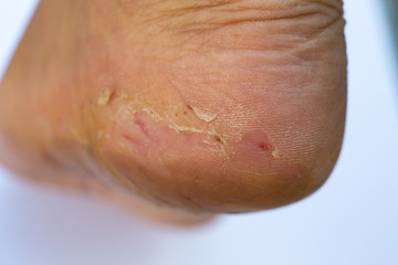 Woman's heel break and peeling, Dermatitis of foot, On white background, Close up and macro shot, Selective focus, Asian Body skin part, Healthcare concept