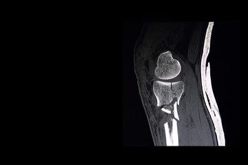 CT scan of knee
