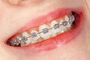 Close-up dental braces on the white teeth of a young girl. Smile healthy concept