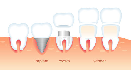 Teeth Problems. Diseased Tooth in Gum. Stomatology