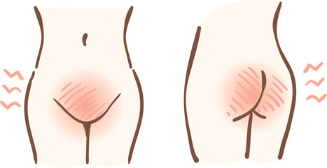 デリケートゾーン　肌トラブル