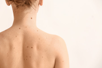 Young woman with moles on white background