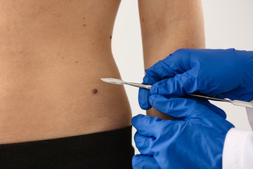 Doctor with lancet going to remove mole from patient's skin, closeup