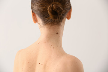 Young woman with moles on light background - obrazy, fototapety, plakaty