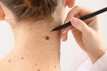 Dermatologist applying marks onto patient's skin before moles removal, closeup