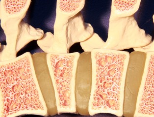 Model of spine showing porous bone marrow in case of osteoporosis