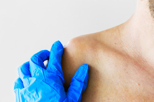 Dislocation or fracture of the clavicle and acromial process with displacement. The doctor examines the patient with a dislocation and fracture of the clavicle and acromial process, close-up