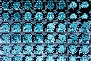 MRI scan of the brain