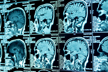 MRI scan of the brain