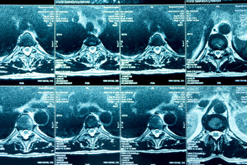 MRI of the thoracic spine