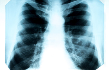 X-ray of the chest